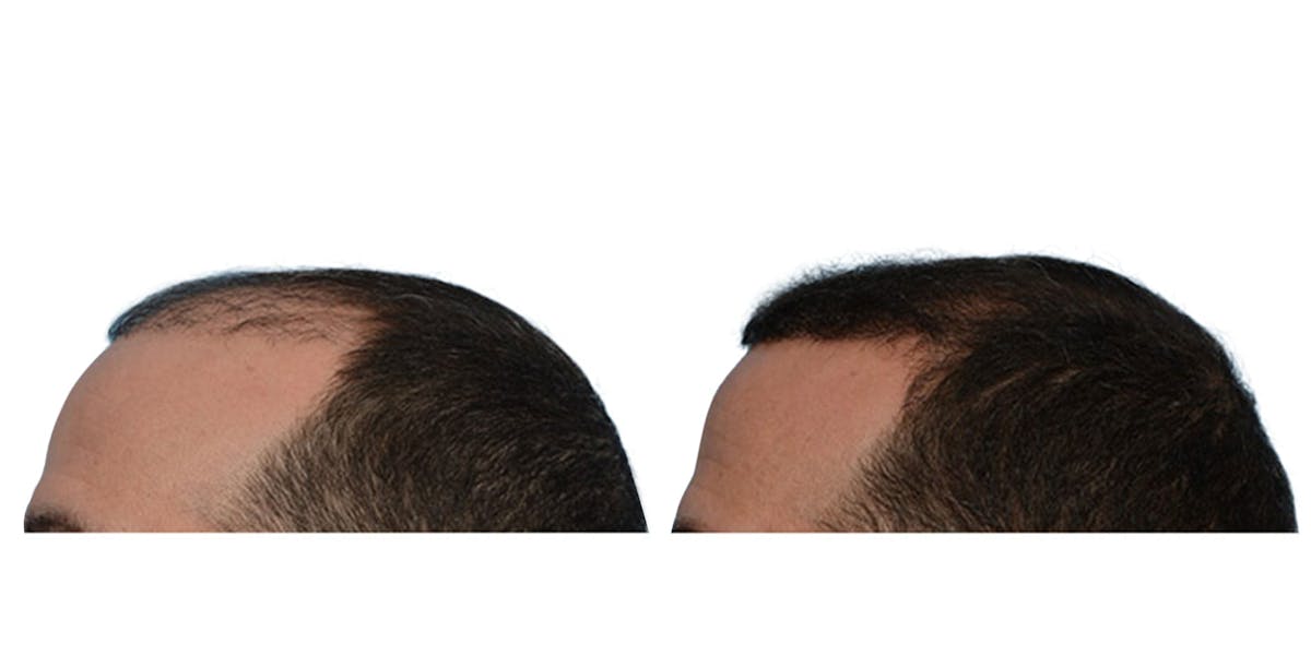 Hair Restoration Before & After Gallery - Patient 354862 - Image 3