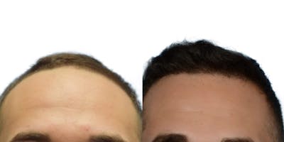 FUE Hair Transplant Before & After Gallery - Patient 403372 - Image 1
