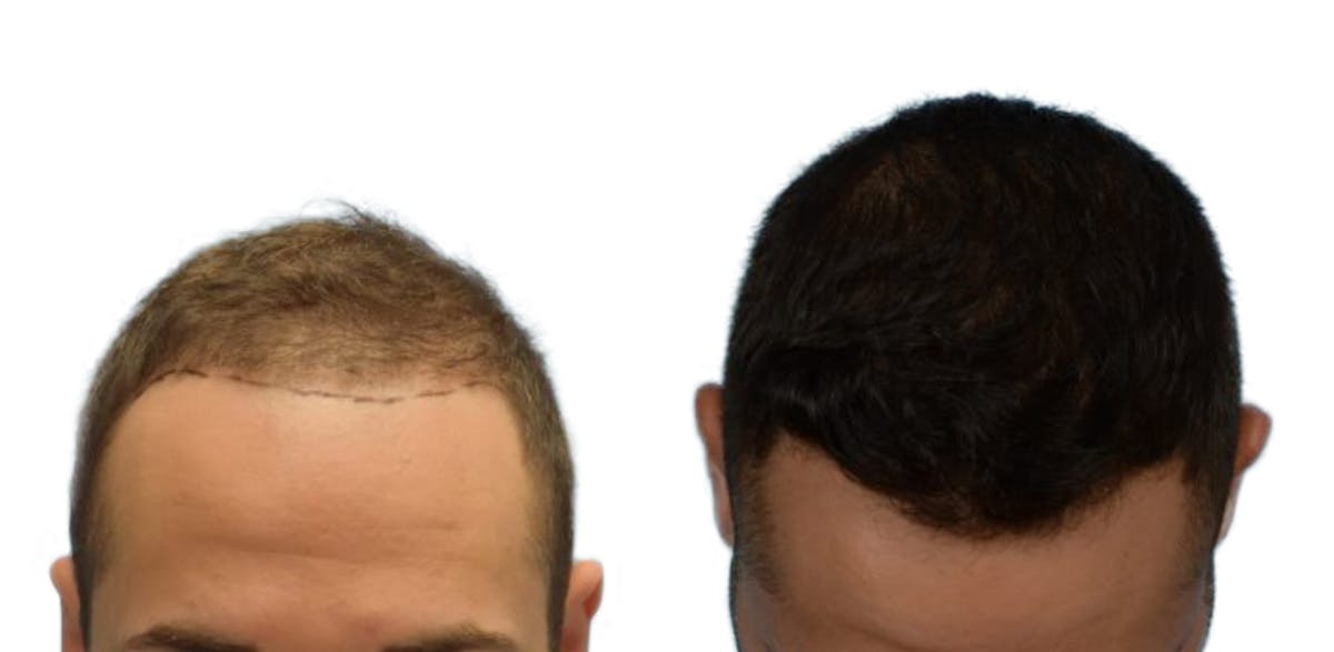 Hair Restoration Before & After Gallery - Patient 164270 - Image 2