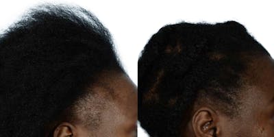 FUE Hair Transplant Before & After Gallery - Patient 773581 - Image 1