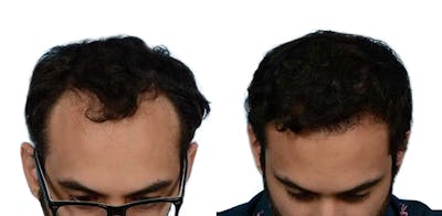 FUE Hair Transplant Before & After Gallery - Patient 287974 - Image 1