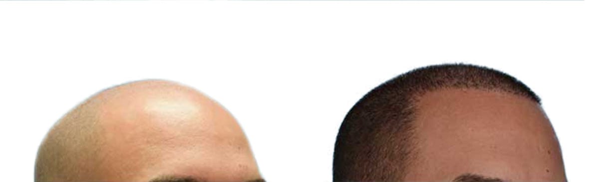 Hair Restoration Before & After Gallery - Patient 213690 - Image 1
