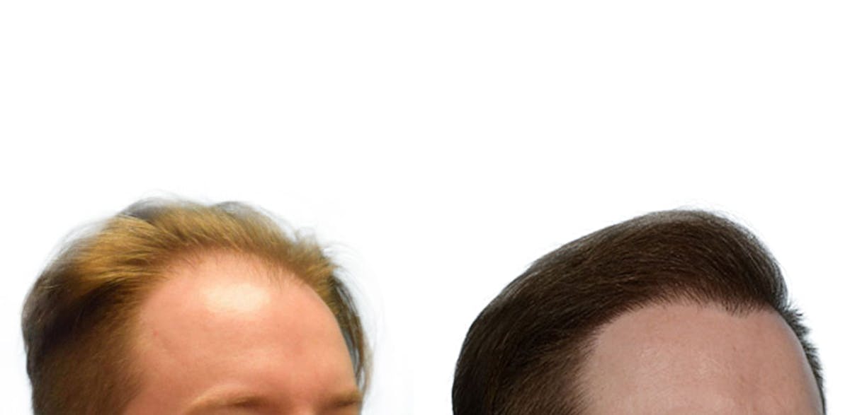FUE Hair Transplant Before & After Gallery - Patient 376300 - Image 2