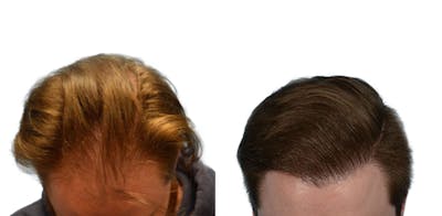 FUE Hair Transplant Before & After Gallery - Patient 376300 - Image 1