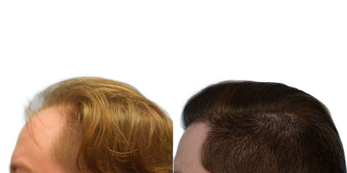 FUE Hair Transplant Before & After Gallery - Patient 376300 - Image 3