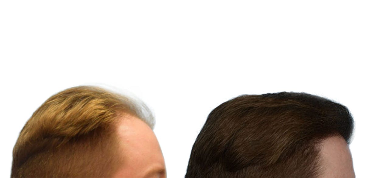 FUE Hair Transplant Before & After Gallery - Patient 376300 - Image 4