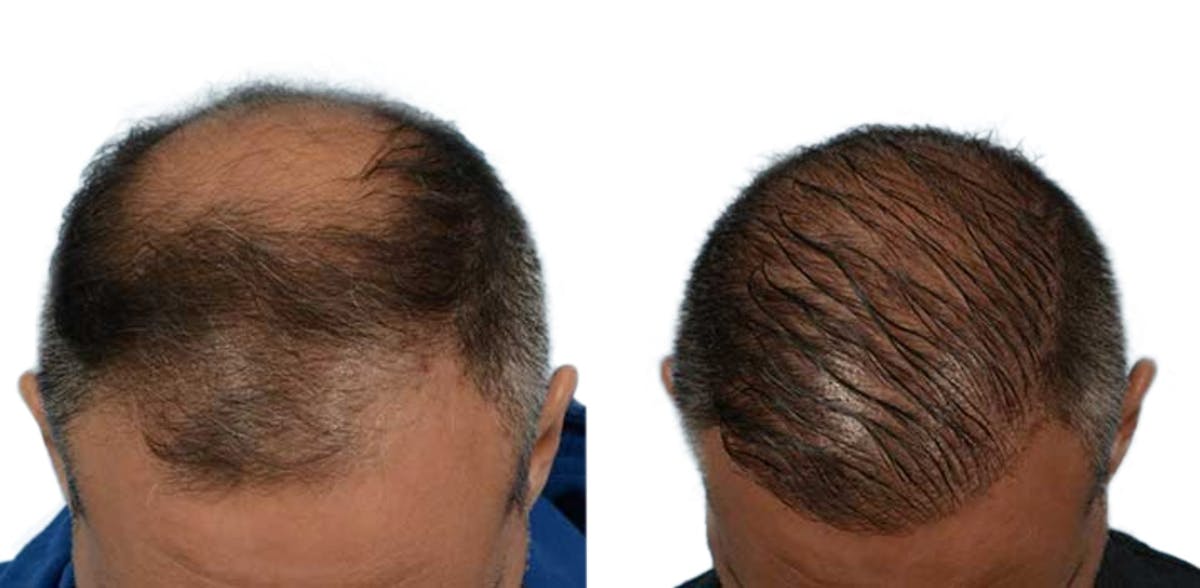FUE Hair Transplant Before & After Gallery - Patient 401446 - Image 1