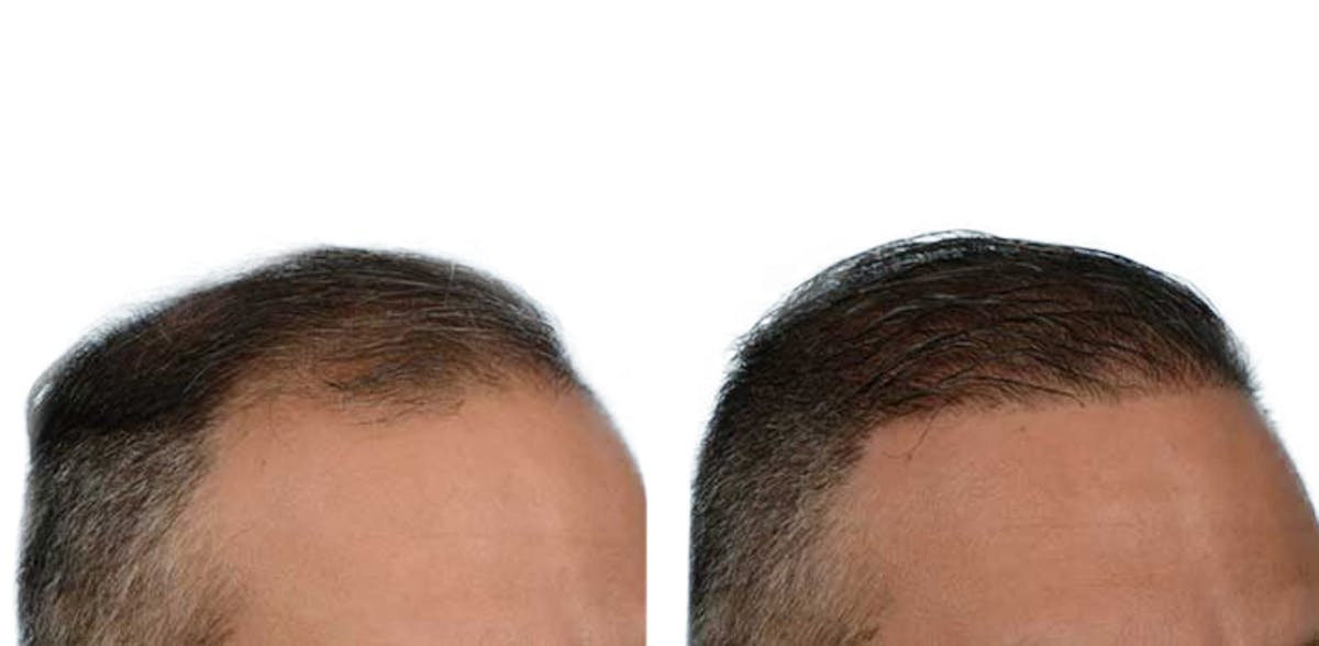 FUE Hair Transplant Before & After Gallery - Patient 401446 - Image 2