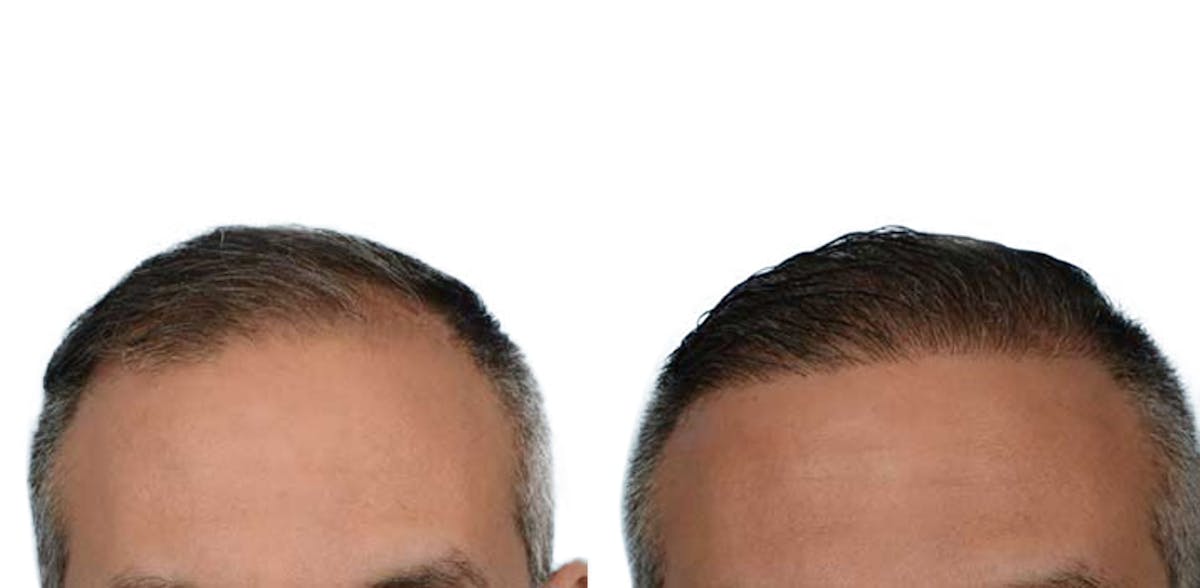 Hair Restoration Before & After Gallery - Patient 291453 - Image 3