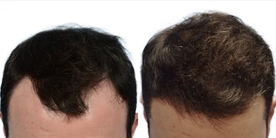 Hair Restoration Before & After Gallery - Patient 121043 - Image 1