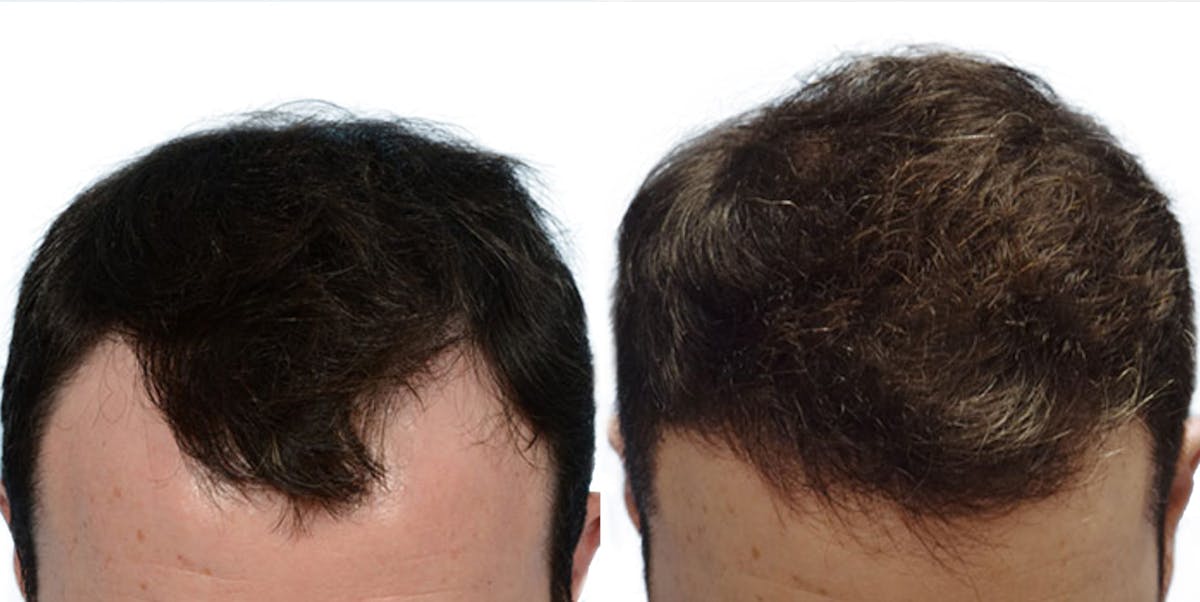 FUE Hair Transplant Before & After Gallery - Patient 169384 - Image 1