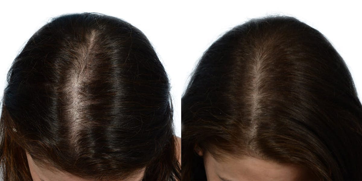 FUE Hair Transplant Before & After Gallery - Patient 433567 - Image 1