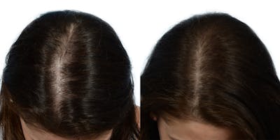 Female Hair Restoration Before & After Gallery - Patient 636009 - Image 1