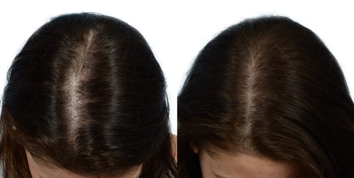 Female Hair Restoration Before & After Gallery - Patient 636009 - Image 1