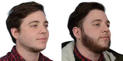 Facial Hair Transplant Before & After Gallery - Patient 197133 - Image 1