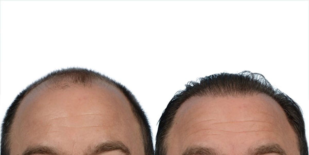 FUE Hair Transplant Before & After Gallery - Patient 640736 - Image 2
