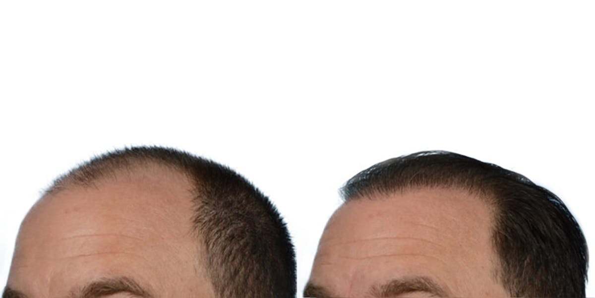 FUE Hair Transplant Before & After Gallery - Patient 640736 - Image 3