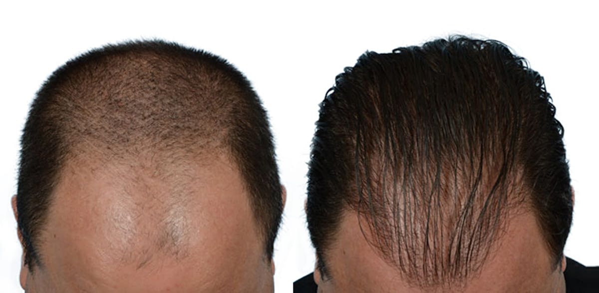 FUE Hair Transplant Before & After Gallery - Patient 640736 - Image 1