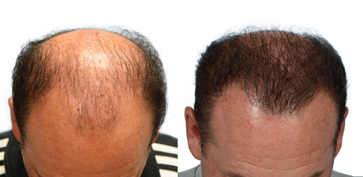 Hair Restoration Before & After Gallery - Patient 158823 - Image 1