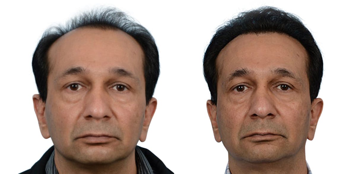 Hair Restoration Before & After Gallery - Patient 309710 - Image 2