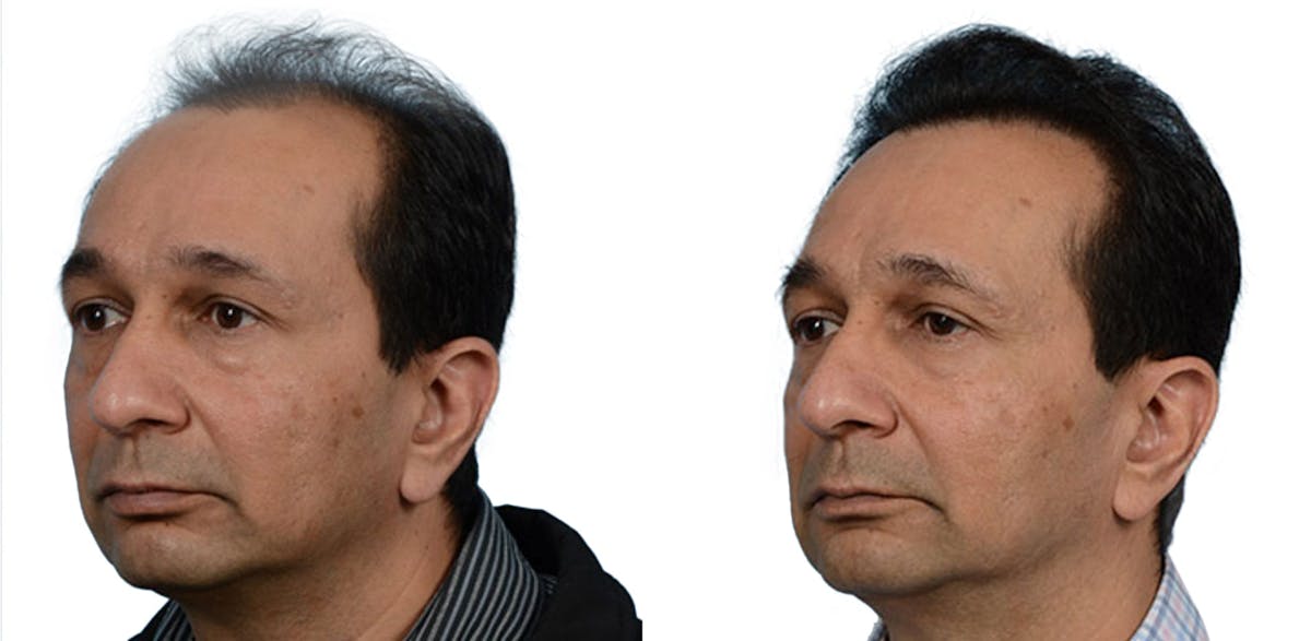 Hair Restoration Before & After Gallery - Patient 309710 - Image 3