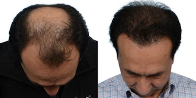 FUE Hair Transplant Before & After Gallery - Patient 229964 - Image 1