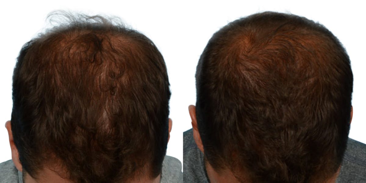 FUE Hair Transplant Before & After Gallery - Patient 370280 - Image 1