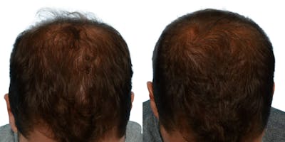 FUE Hair Transplant Before & After Gallery - Patient 370280 - Image 1