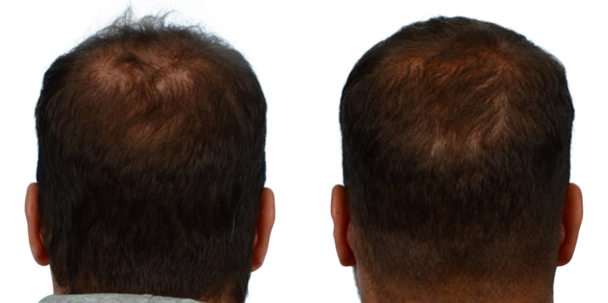 Hair Restoration Before & After Gallery - Patient 199422 - Image 2