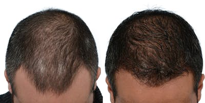 Hair Restoration Before & After Gallery - Patient 597518 - Image 1