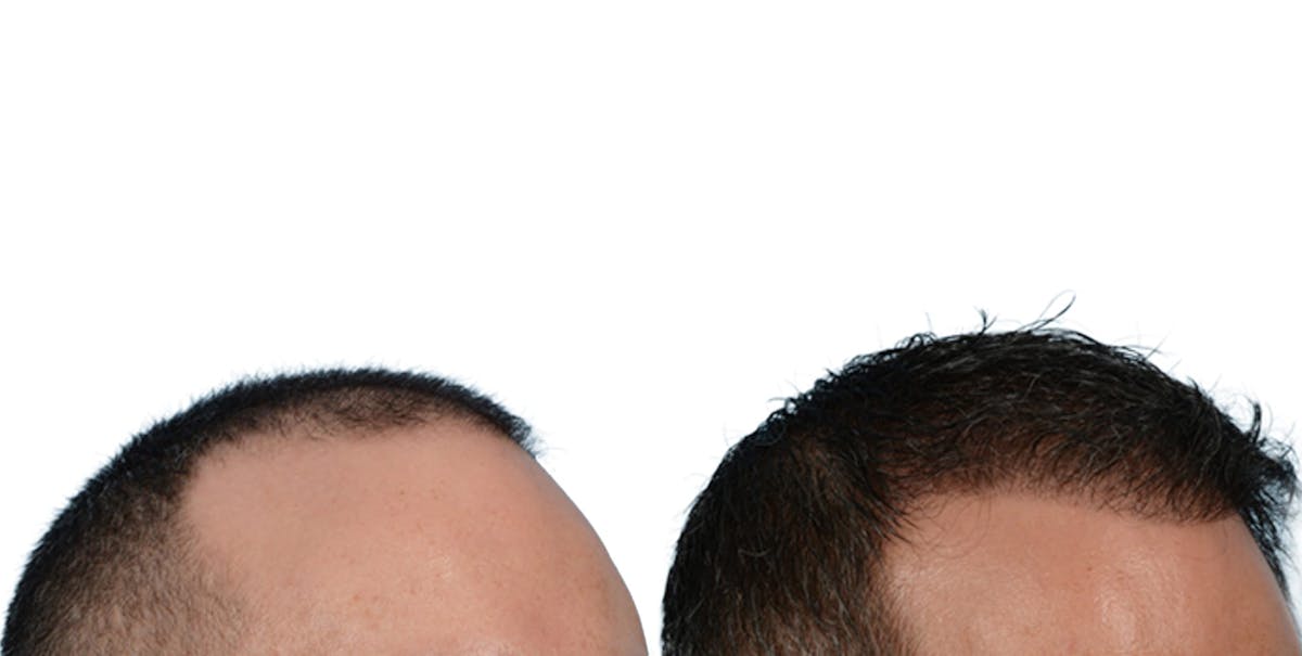 Hair Restoration Before & After Gallery - Patient 597518 - Image 2
