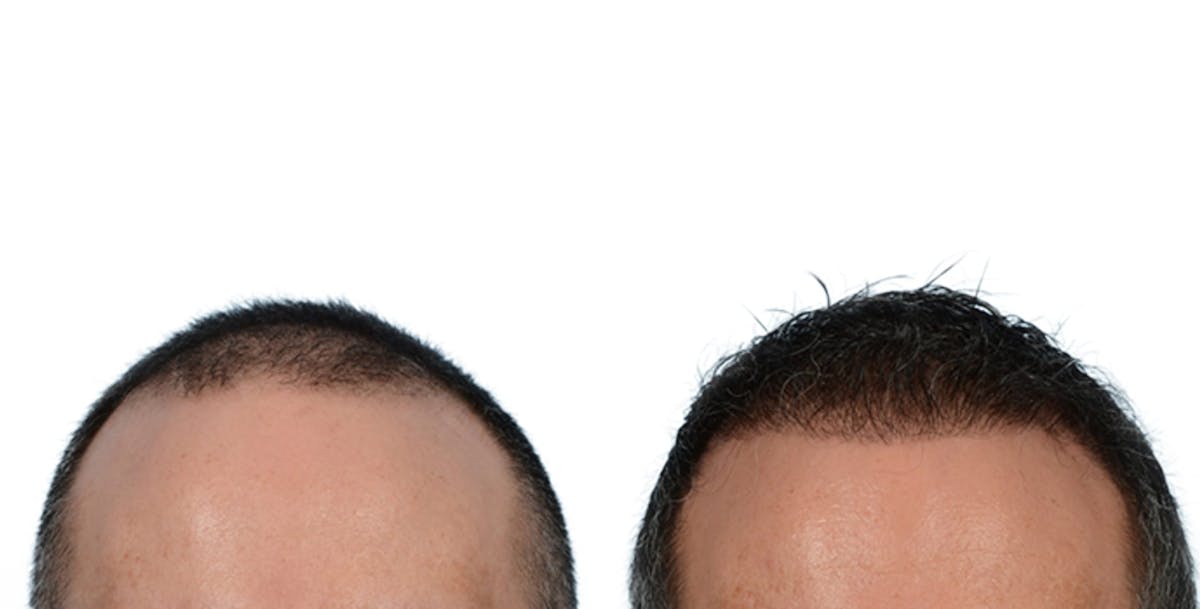 Hair Restoration Before & After Gallery - Patient 597518 - Image 3