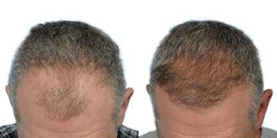 FUE Hair Transplant Before & After Gallery - Patient 559980 - Image 1