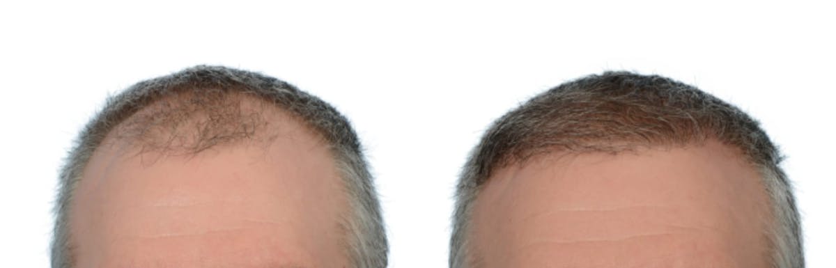 Hair Restoration Before & After Gallery - Patient 223905 - Image 2