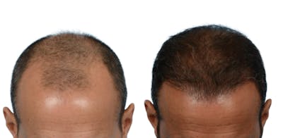 FUE Hair Transplant Before & After Gallery - Patient 442725 - Image 1