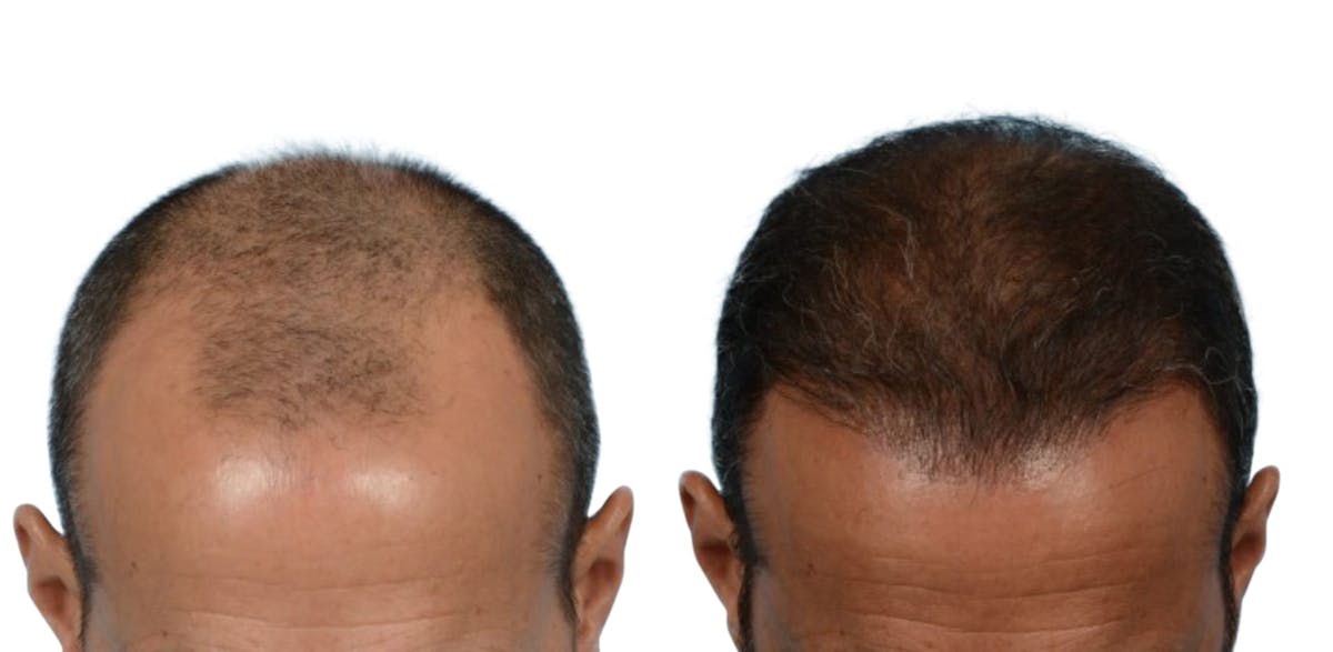 FUE Hair Transplant Before & After Gallery - Patient 442725 - Image 1