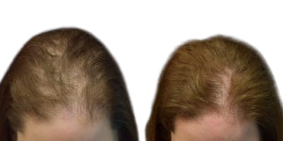 Hair Restoration Before & After Gallery - Patient 425939 - Image 1