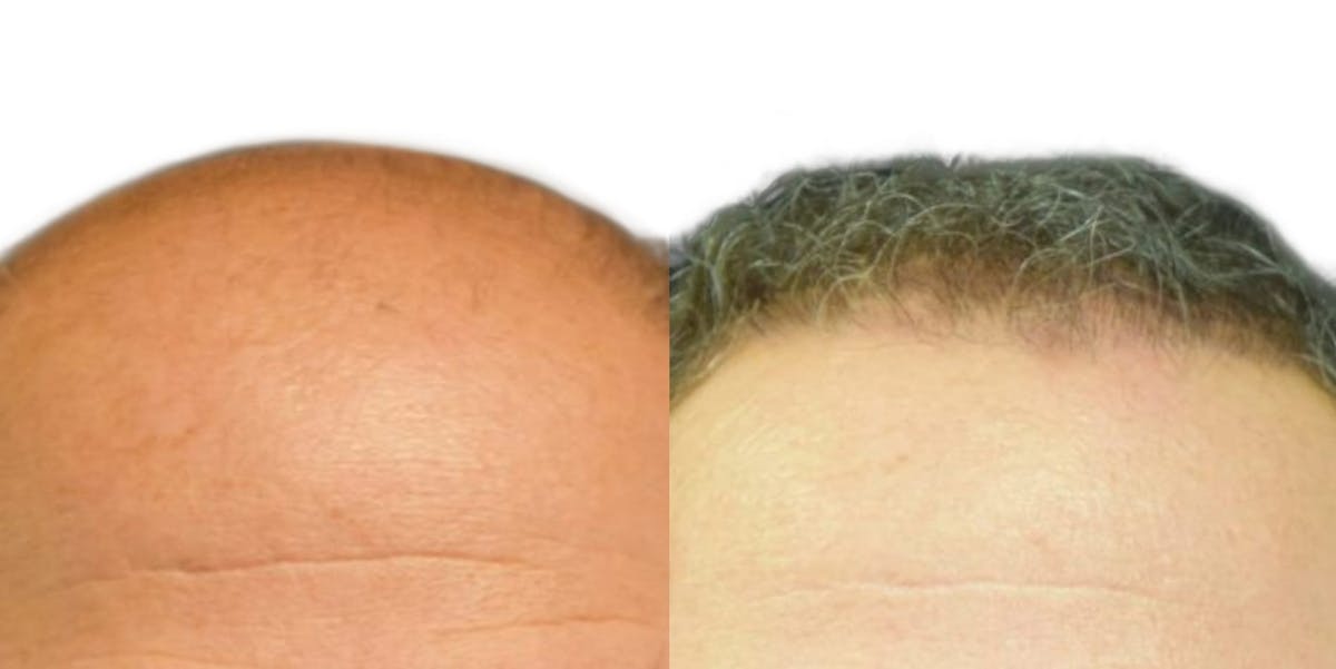 Hair Restoration Before & After Gallery - Patient 216907 - Image 2