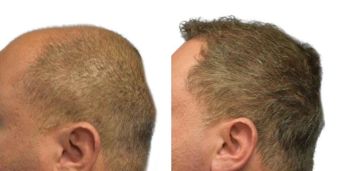 FUE Hair Transplant Before & After Gallery - Patient 131456 - Image 3