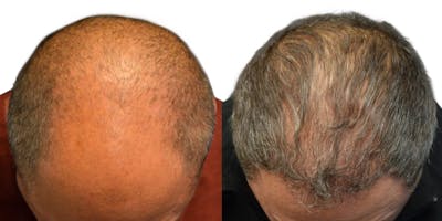 FUE Hair Transplant Before & After Gallery - Patient 131456 - Image 1
