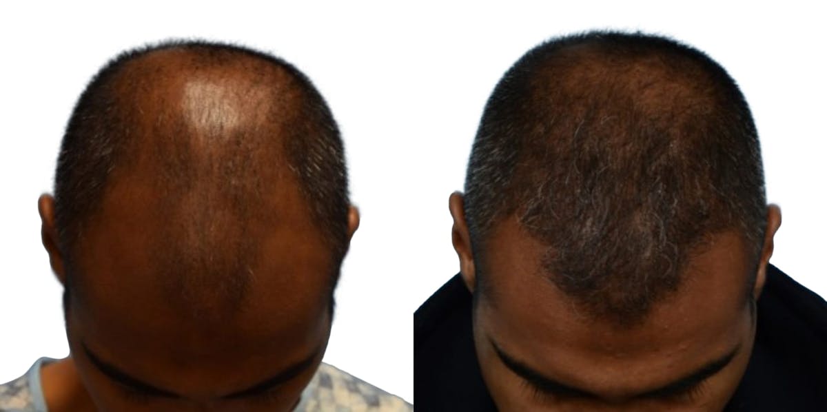 FUE Hair Transplant Before & After Gallery - Patient 121786 - Image 1