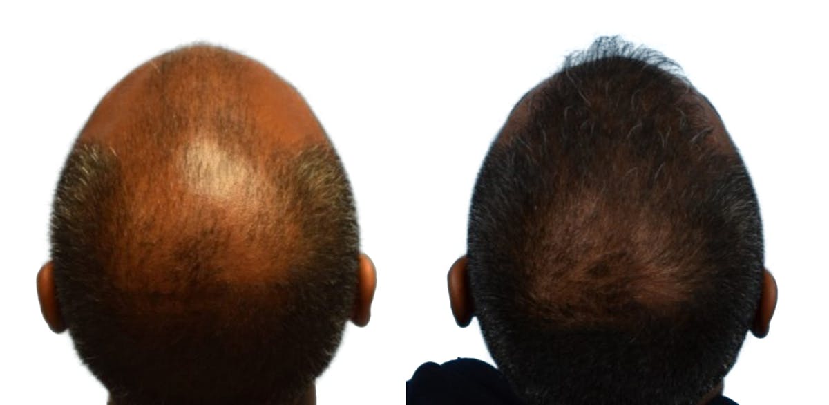 Hair Restoration Before & After Gallery - Patient 185916 - Image 2