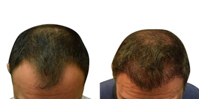 FUE Hair Transplant Before & After Gallery - Patient 411359 - Image 1