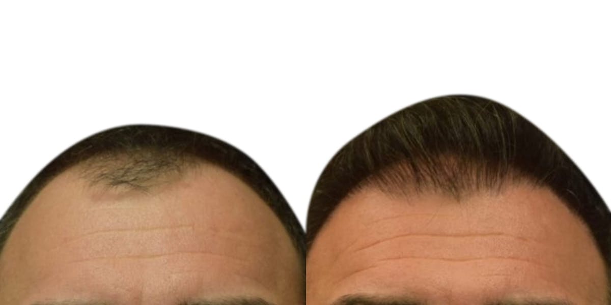 FUE Hair Transplant Before & After Gallery - Patient 411359 - Image 2