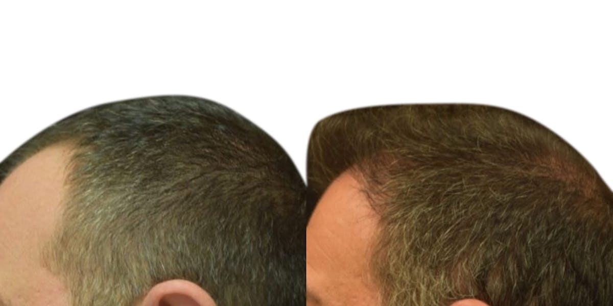 Hair Restoration Before & After Gallery - Patient 106167 - Image 3