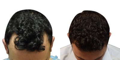 FUE Hair Transplant Before & After Gallery - Patient 177454 - Image 1