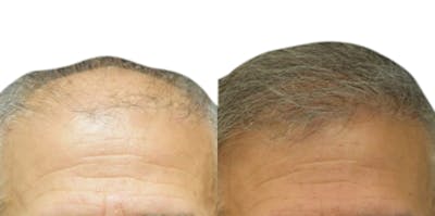 FUE Hair Transplant Before & After Gallery - Patient 300657 - Image 1
