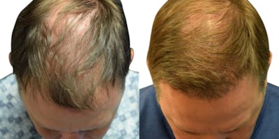 FUE Hair Transplant Before & After Gallery - Patient 350516 - Image 1