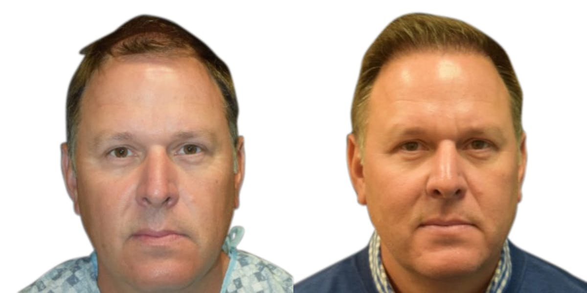 FUE Hair Transplant Before & After Gallery - Patient 350516 - Image 2