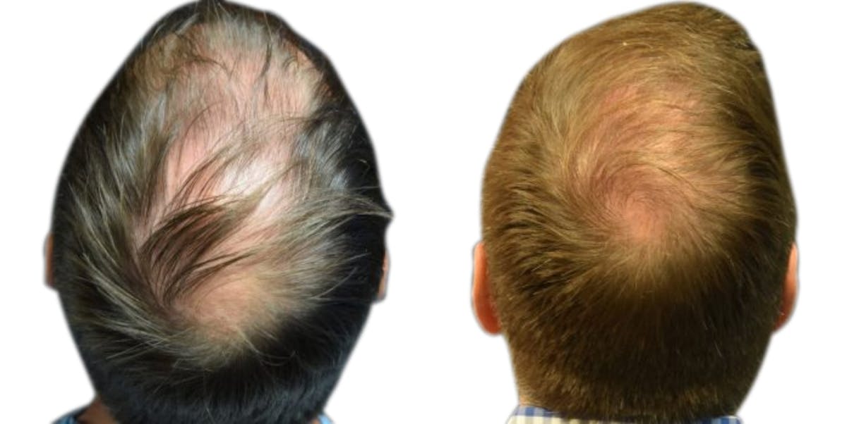 FUE Hair Transplant Before & After Gallery - Patient 350516 - Image 3